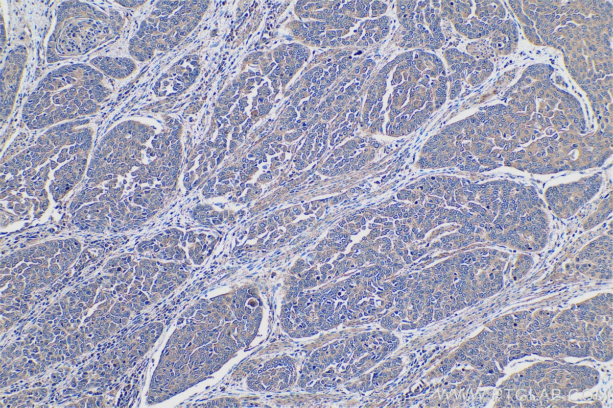 Immunohistochemical analysis of paraffin-embedded human oesophagus cancer tissue slide using KHC0475 (SFRP4 IHC Kit).