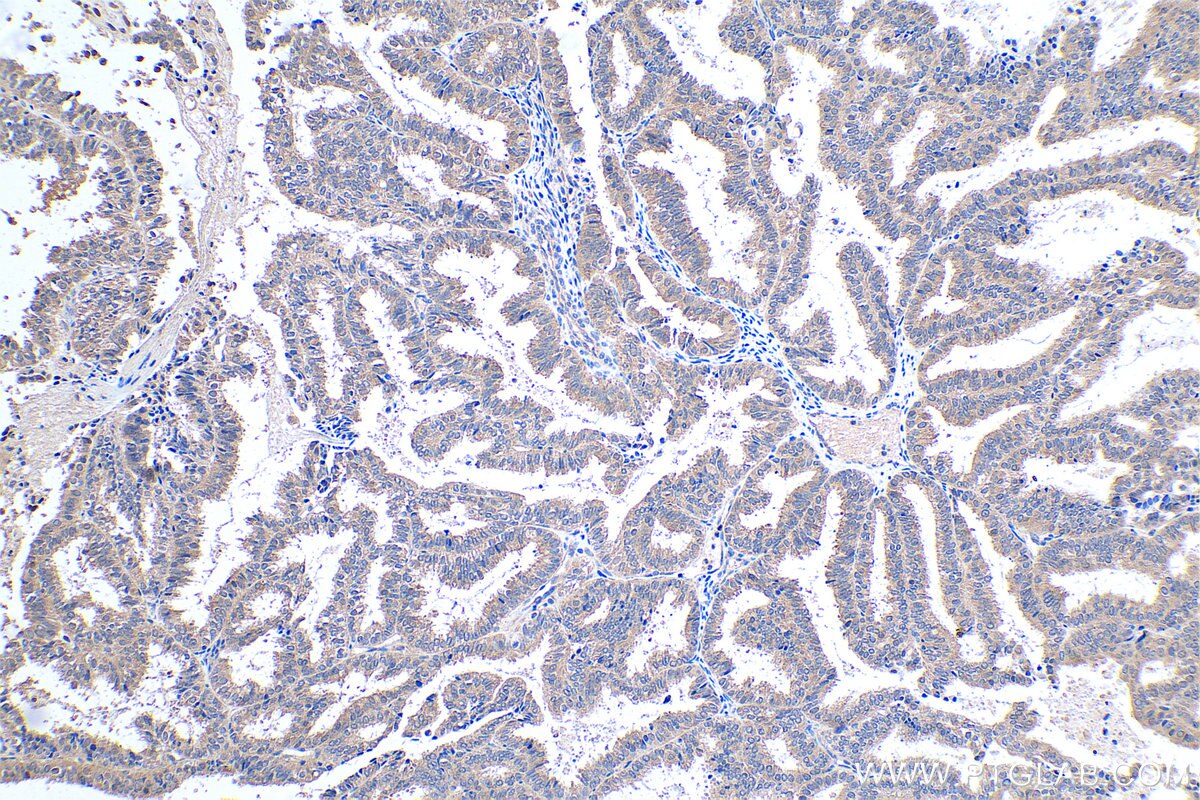 Immunohistochemical analysis of paraffin-embedded human ovary tumor tissue slide using KHC0475 (SFRP4 IHC Kit).