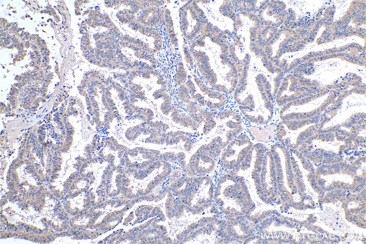 Immunohistochemical analysis of paraffin-embedded human ovary tumor tissue slide using KHC0475 (SFRP4 IHC Kit).