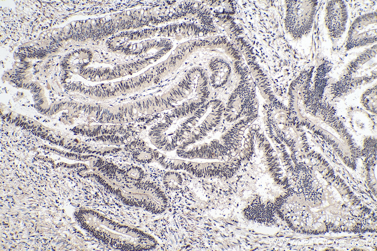 Immunohistochemical analysis of paraffin-embedded human colon cancer tissue slide using KHC0165 (SFRS2 IHC Kit).
