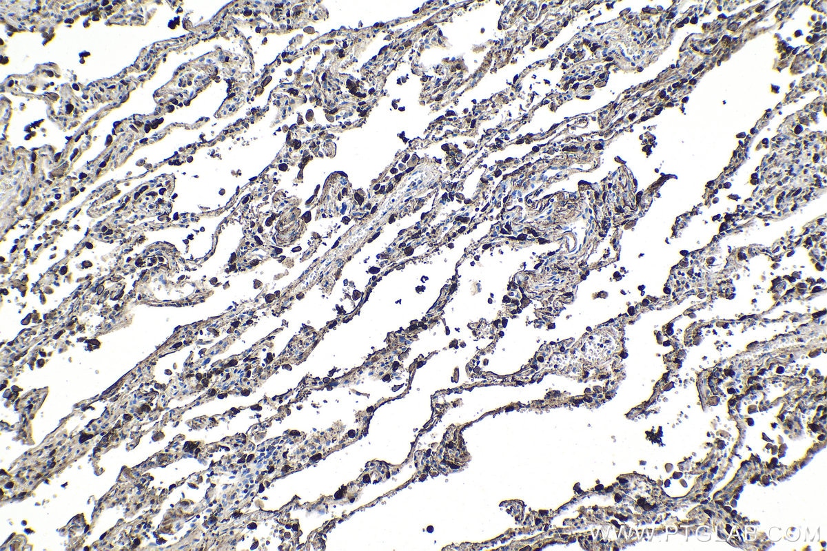 Immunohistochemical analysis of paraffin-embedded human lung tissue slide using KHC1053 (SFTPA1 IHC Kit).