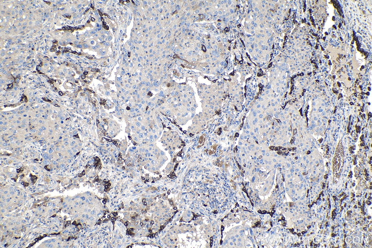 Immunohistochemical analysis of paraffin-embedded human lung cancer tissue slide using KHC1053 (SFTPA1 IHC Kit).