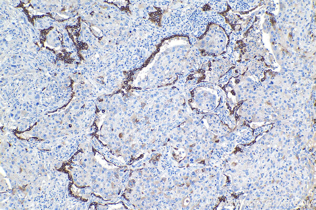 Immunohistochemical analysis of paraffin-embedded human lung cancer tissue slide using KHC1099 (SFTPB IHC Kit).