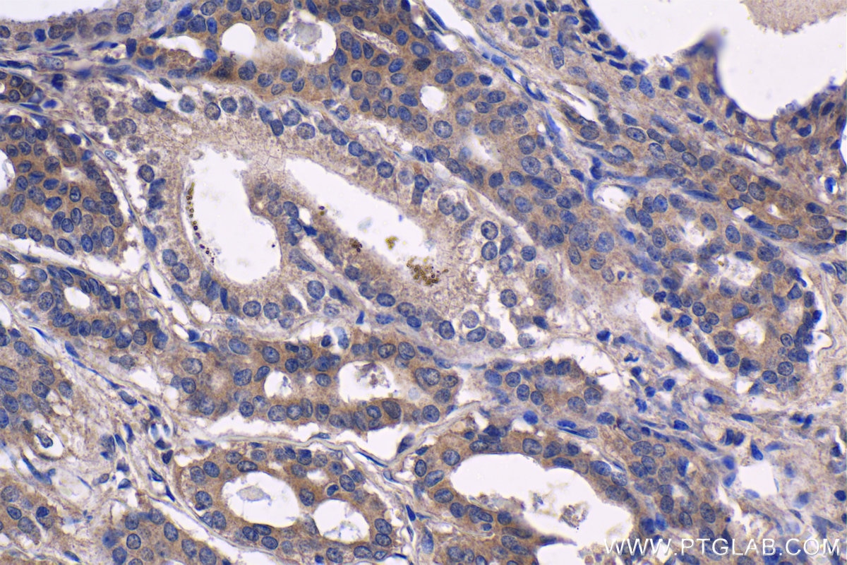 Immunohistochemical analysis of paraffin-embedded human breast cancer tissue slide using KHC1416 (SGK1 IHC Kit).