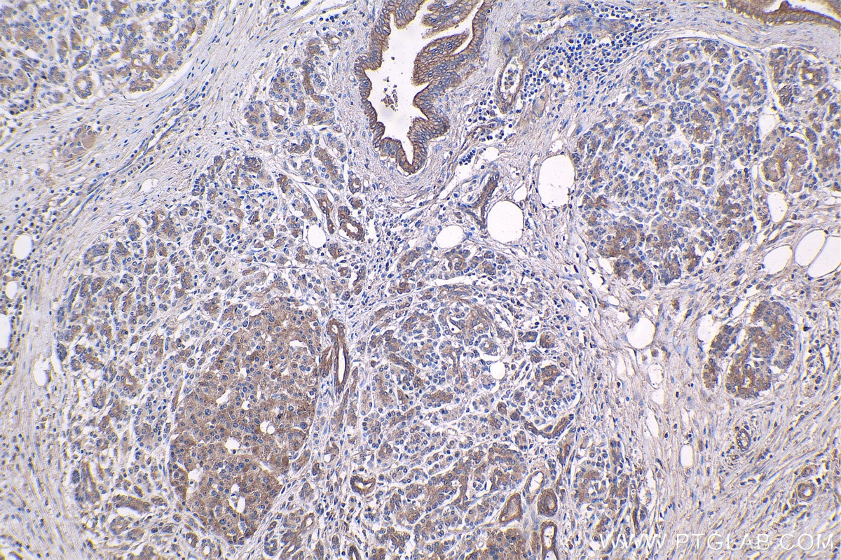 Immunohistochemical analysis of paraffin-embedded human pancreas cancer tissue slide using KHC1416 (SGK1 IHC Kit).
