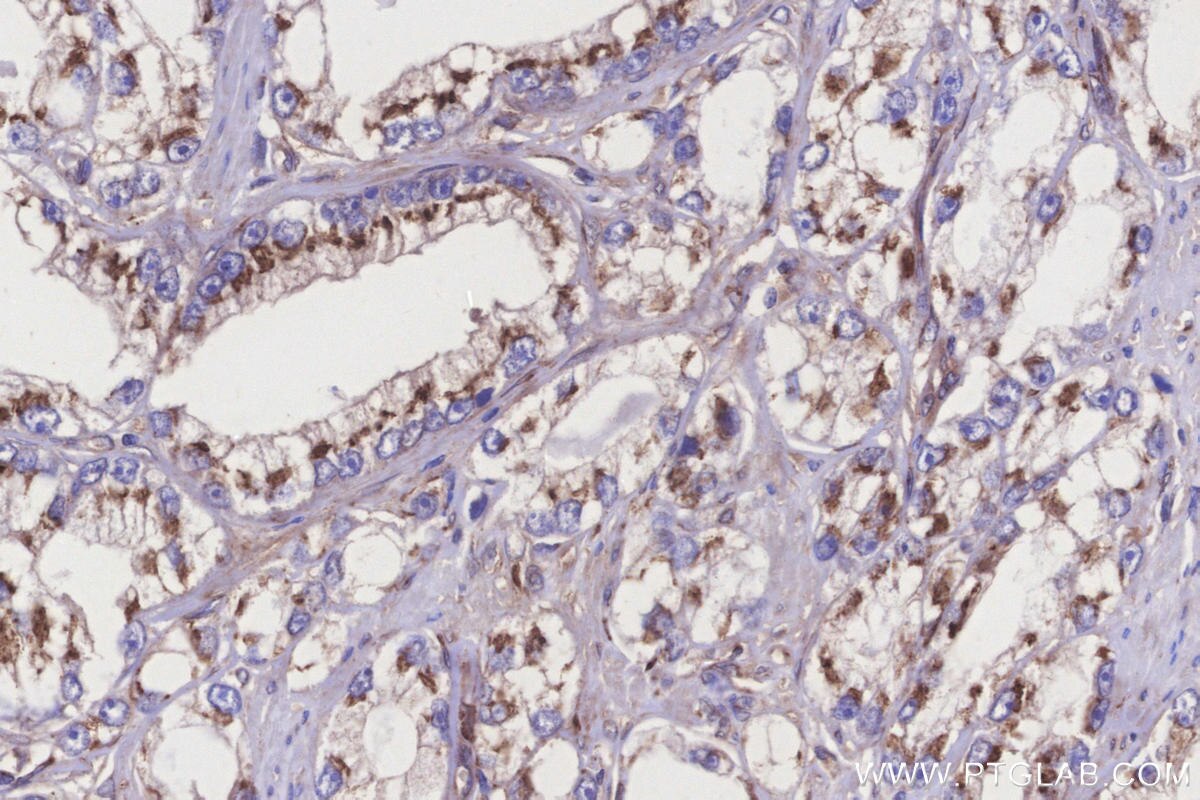 Immunohistochemical analysis of paraffin-embedded human prostate cancer tissue slide using KHC3284 (SGMS1 IHC Kit).