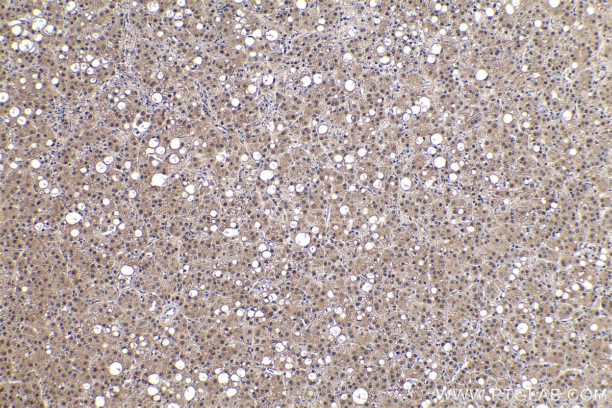 Immunohistochemical analysis of paraffin-embedded human liver cancer tissue slide using KHC0875 (SGTA IHC Kit).
