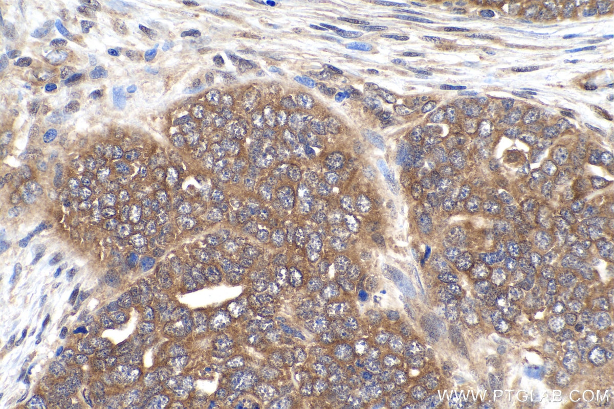 Immunohistochemical analysis of paraffin-embedded human ovary tumor tissue slide using KHC0875 (SGTA IHC Kit).