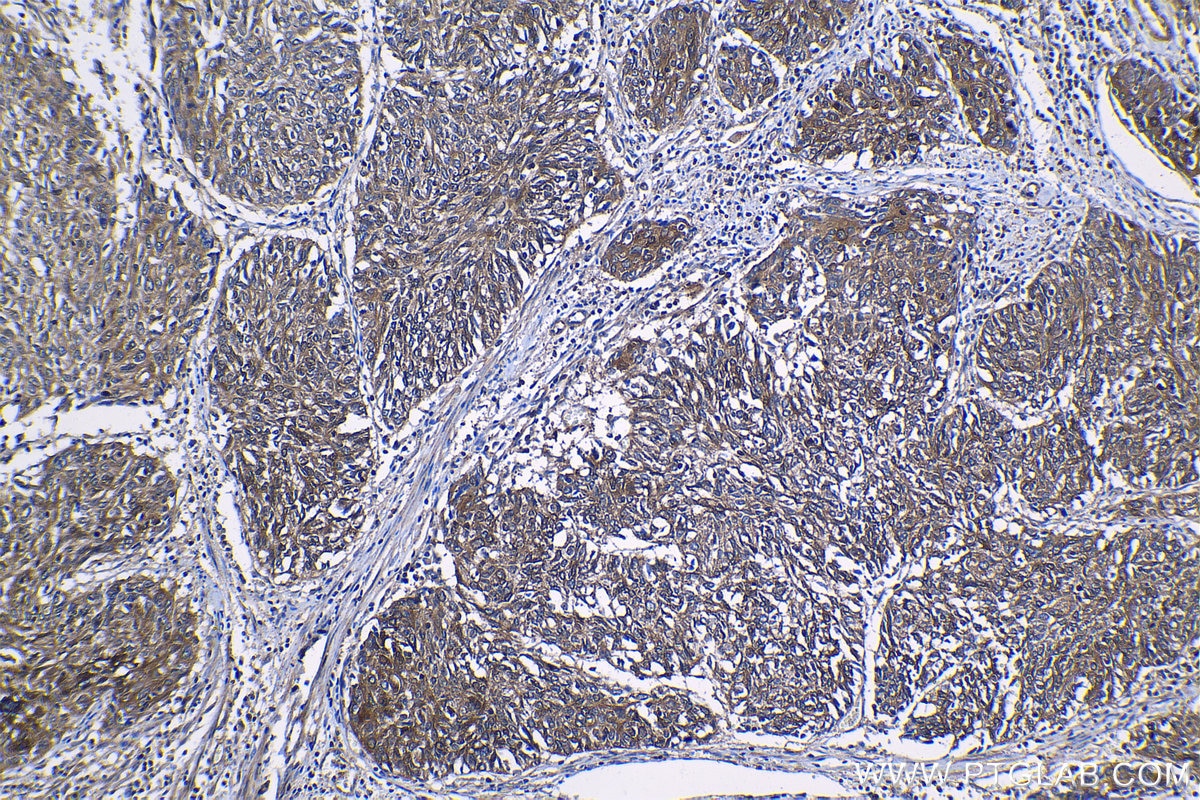 Immunohistochemical analysis of paraffin-embedded human cervical cancer tissue slide using KHC1260 (SH3GLB2 IHC Kit).