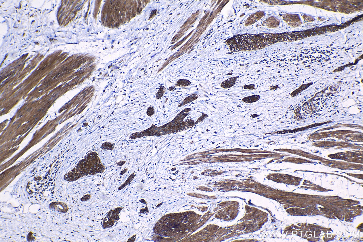 Immunohistochemical analysis of paraffin-embedded human urothelial carcinoma tissue slide using KHC1260 (SH3GLB2 IHC Kit).