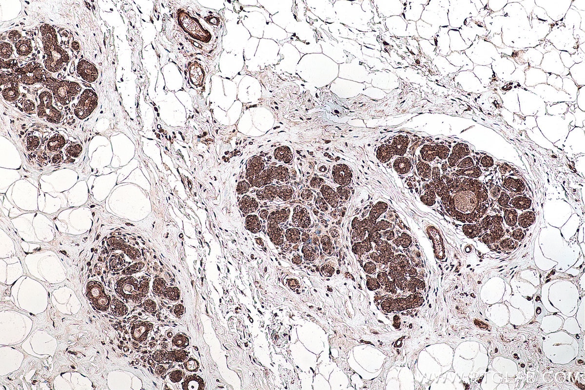 Immunohistochemical analysis of paraffin-embedded human breast cancer tissue slide using KHC0134 (SHH IHC Kit).