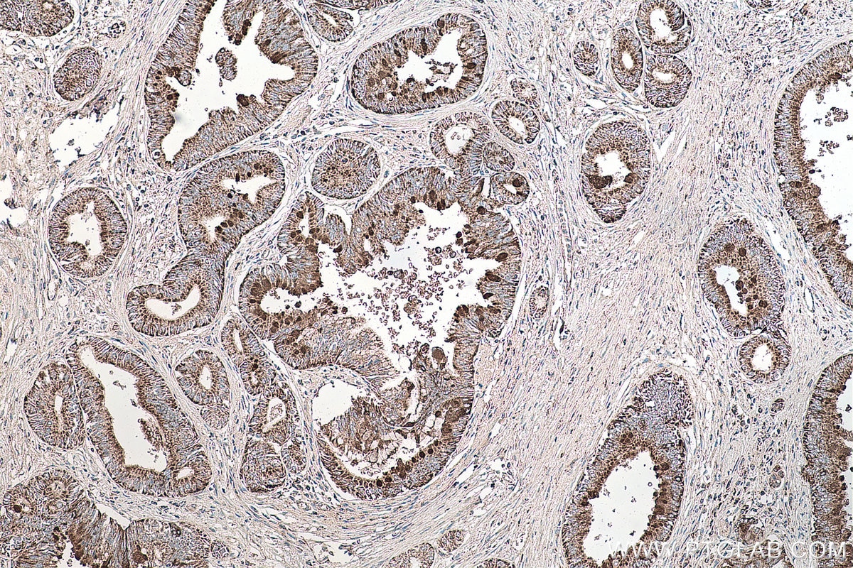 Immunohistochemical analysis of paraffin-embedded human pancreas cancer tissue slide using KHC0134 (SHH IHC Kit).