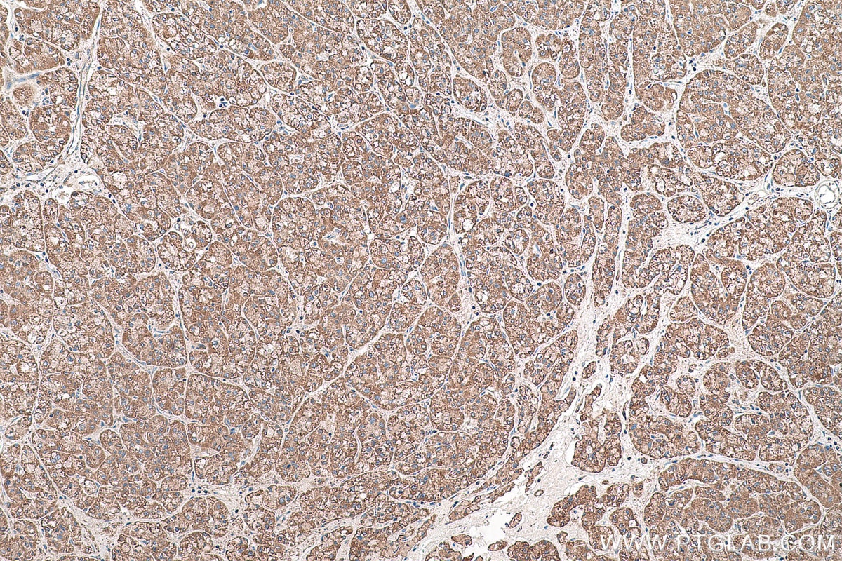 Immunohistochemical analysis of paraffin-embedded human liver cancer tissue slide using KHC0566 (SHMT1 IHC Kit).