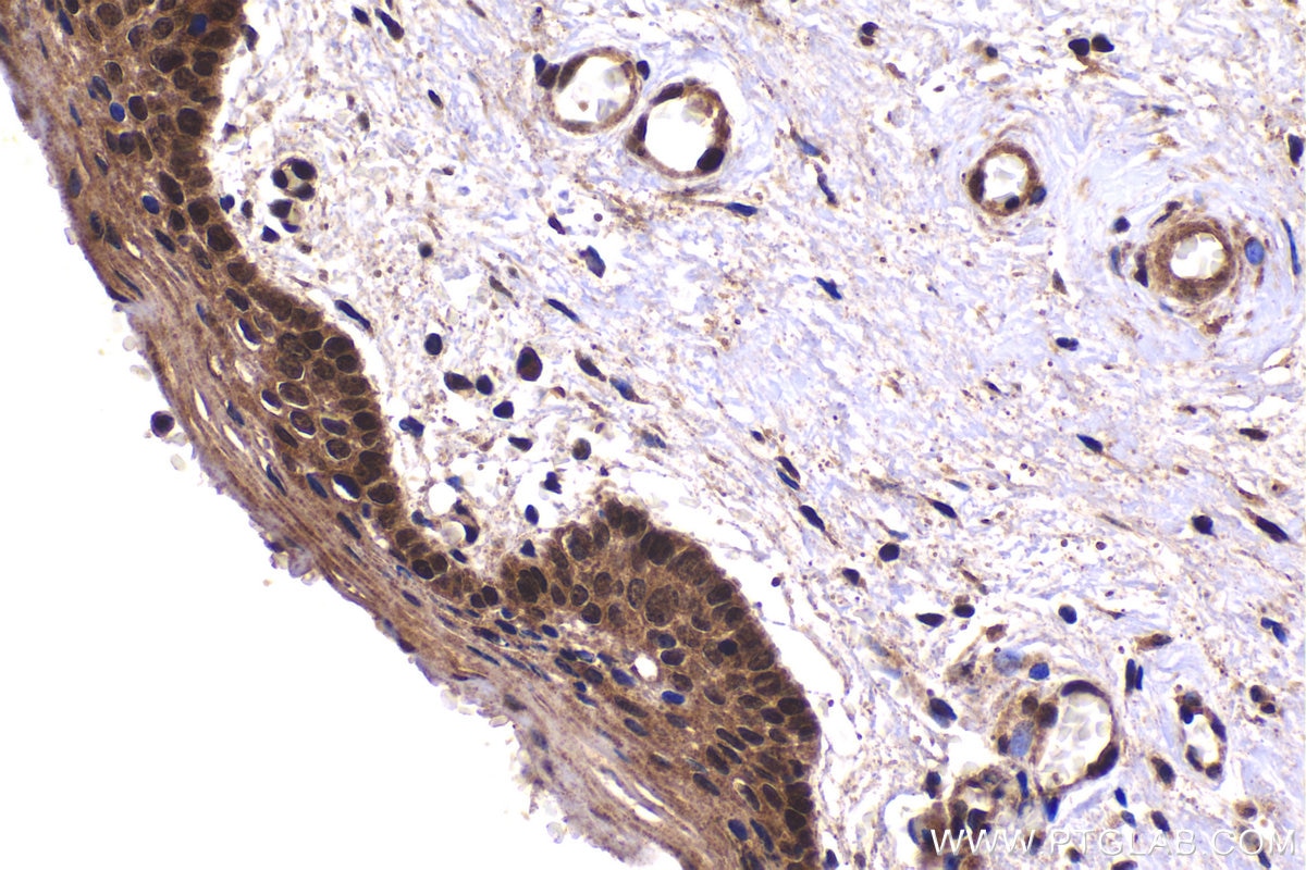 Immunohistochemical analysis of paraffin-embedded human cervical cancer tissue slide using KHC2076 (SIAH2 IHC Kit).
