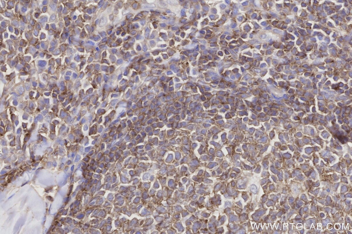 Immunohistochemical analysis of paraffin-embedded human tonsillitis tissue slide using KHC2792 (SIPA1 IHC Kit).
