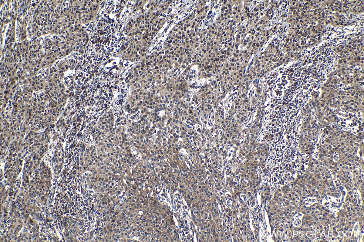 Immunohistochemical analysis of paraffin-embedded human cervical cancer tissue slide using KHC1207 (SIRT1 IHC Kit).