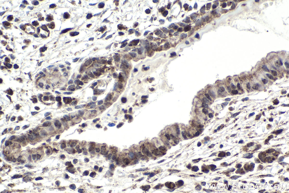 Immunohistochemical analysis of paraffin-embedded human cervical cancer tissue slide using KHC1821 (SIRT2 IHC Kit).