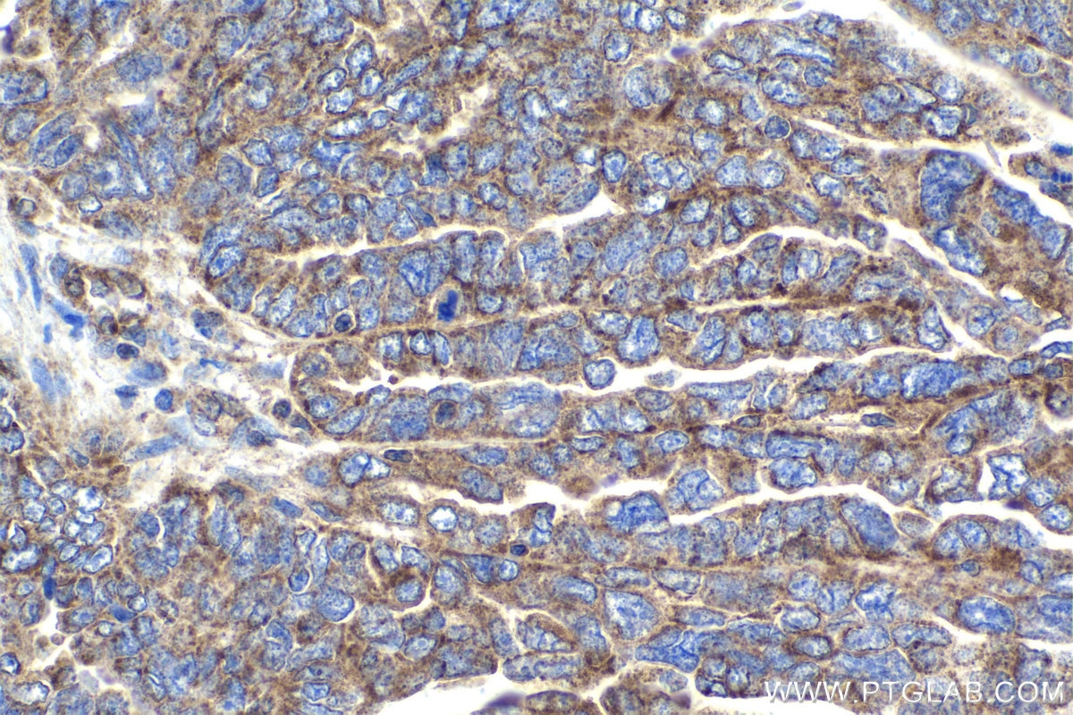 Immunohistochemical analysis of paraffin-embedded human ovary tumor tissue slide using KHC1821 (SIRT2 IHC Kit).