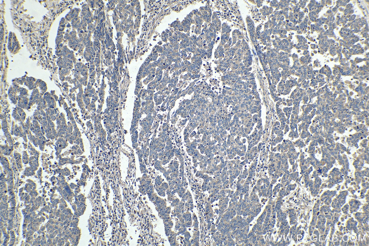 Immunohistochemical analysis of paraffin-embedded human ovary tumor tissue slide using KHC1443 (SIVA1 IHC Kit).
