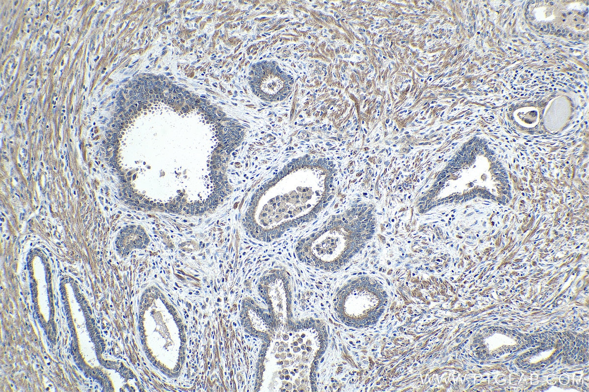 Immunohistochemical analysis of paraffin-embedded human prostate cancer tissue slide using KHC1443 (SIVA1 IHC Kit).