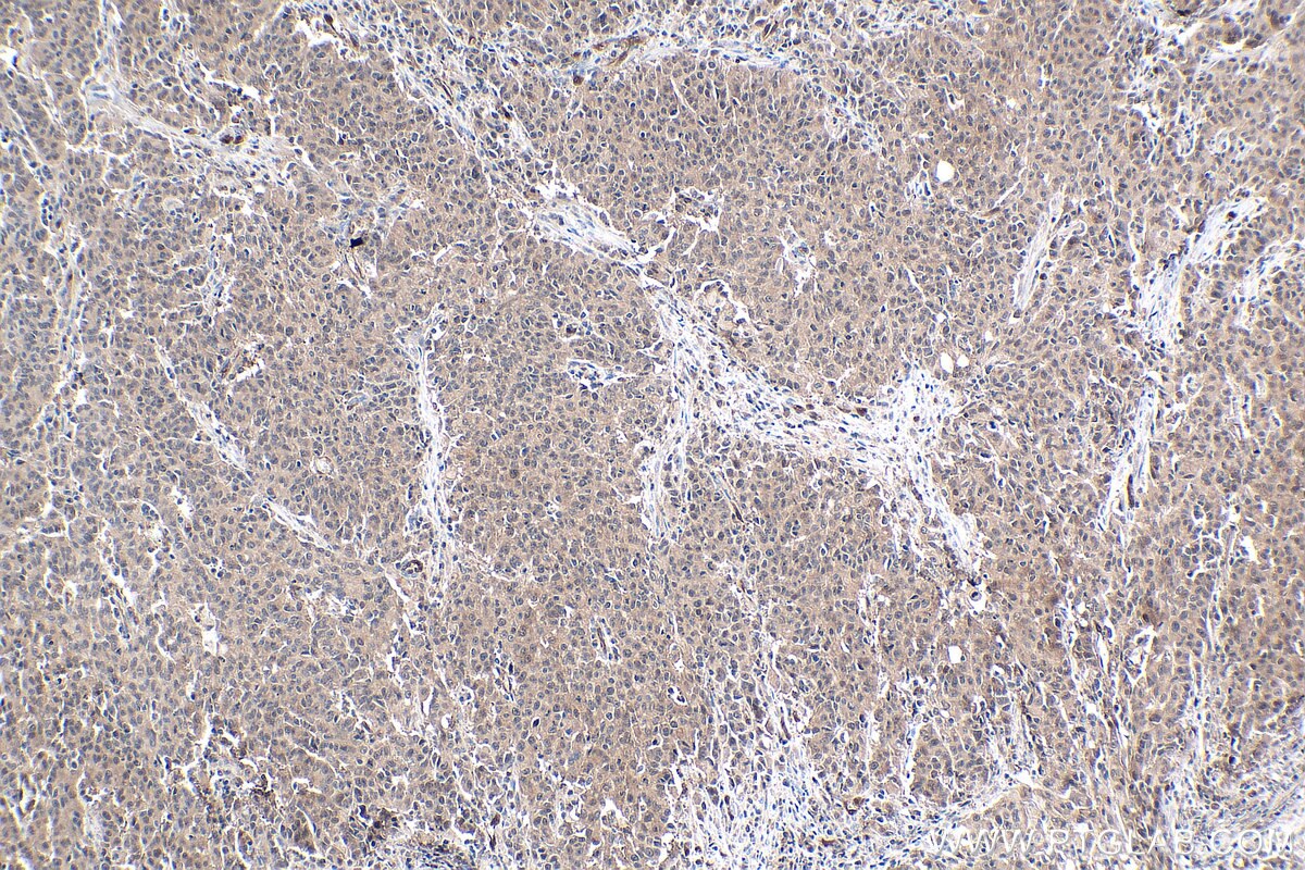 Immunohistochemical analysis of paraffin-embedded human stomach cancer tissue slide using KHC0269 (SIX1 IHC Kit).