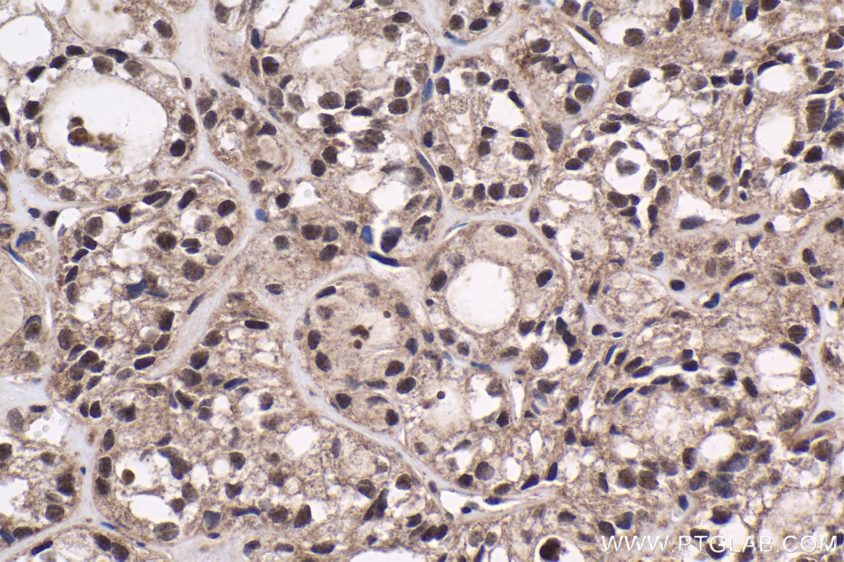 Immunohistochemical analysis of paraffin-embedded human thyroid cancer tissue slide using KHC1830 (SIX5 IHC Kit).