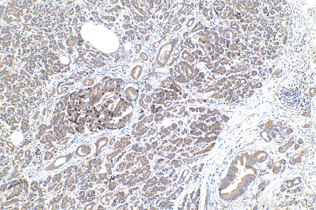 Immunohistochemical analysis of paraffin-embedded human pancreas cancer tissue slide using KHC1768 (SKOR2 IHC Kit).