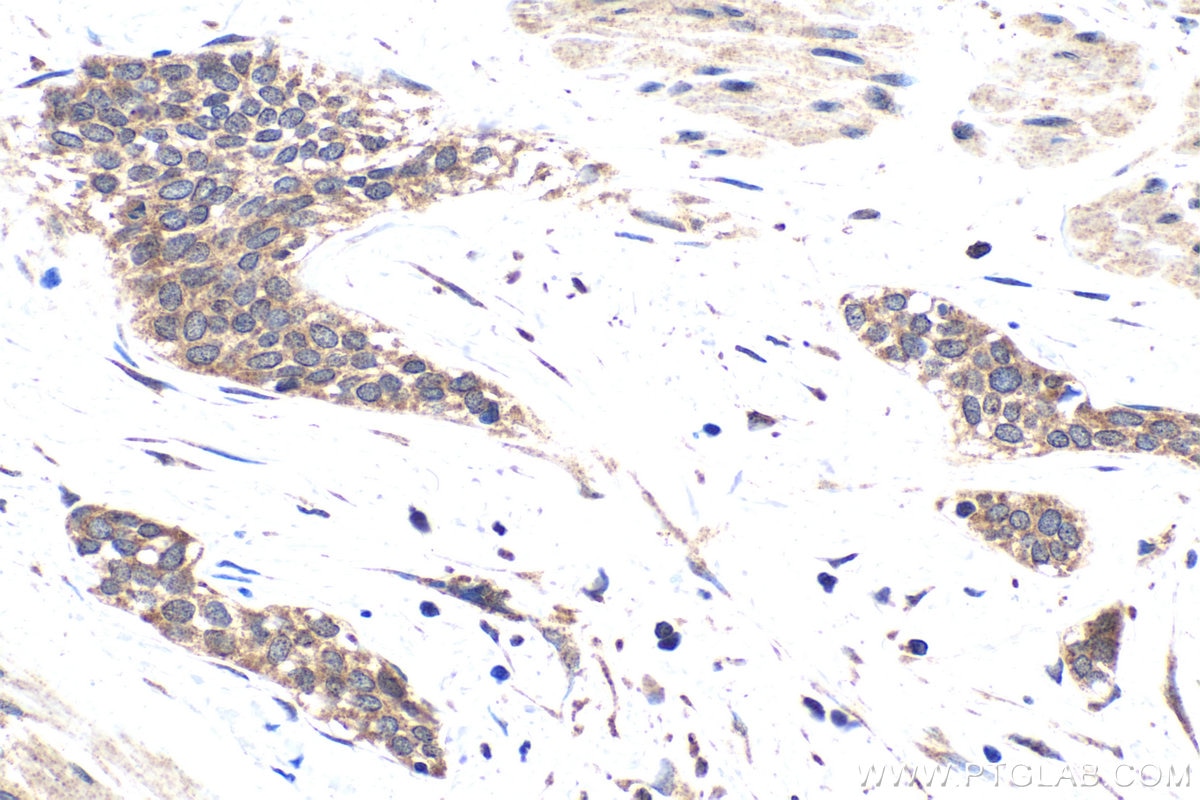 Immunohistochemical analysis of paraffin-embedded human urothelial carcinoma tissue slide using KHC1768 (SKOR2 IHC Kit).