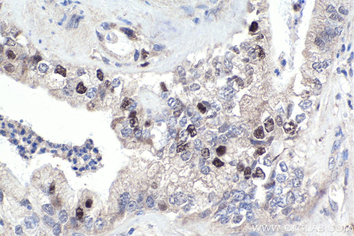 Immunohistochemical analysis of paraffin-embedded human pancreas cancer tissue slide using KHC1709 (SKP2 IHC Kit).