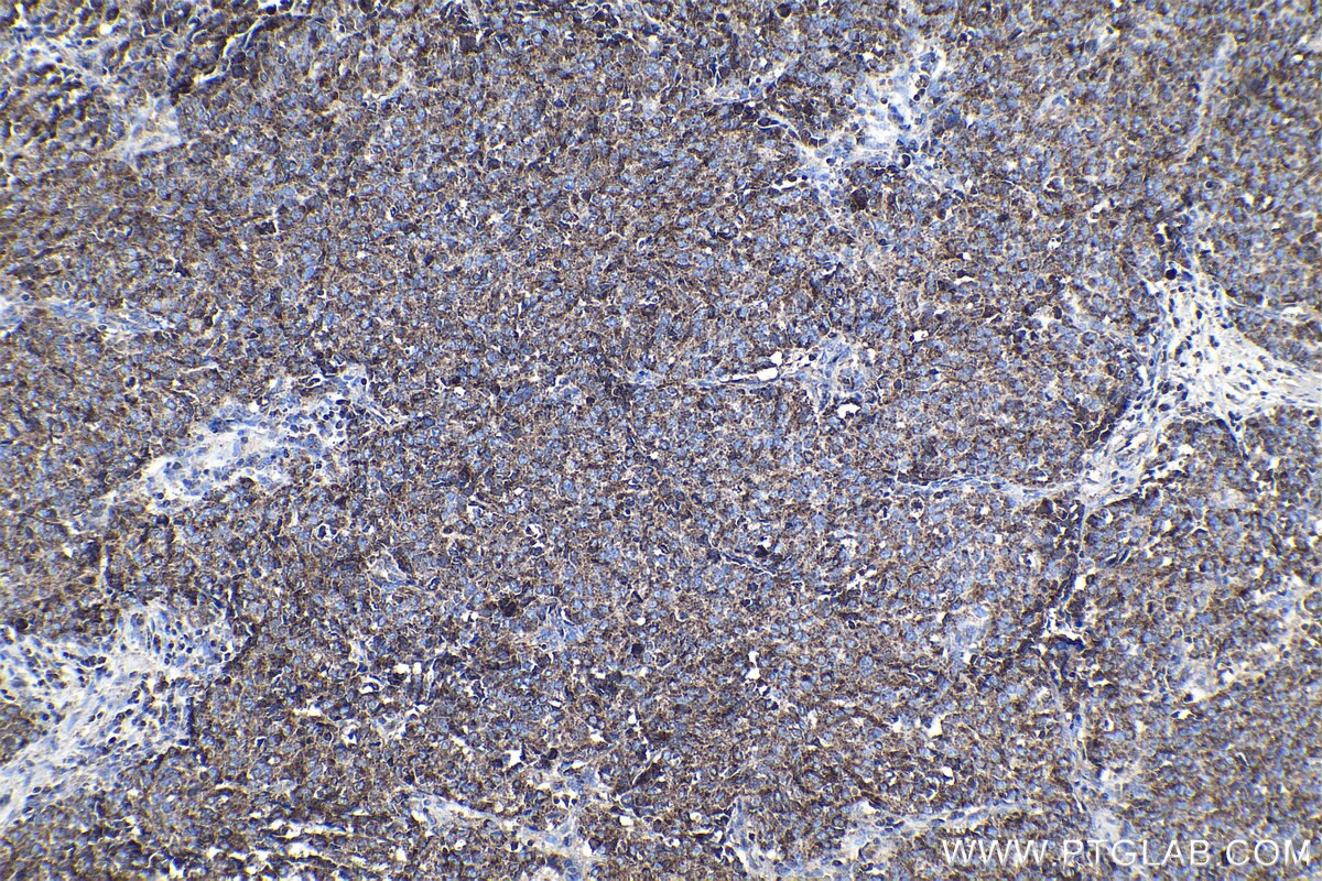 Immunohistochemical analysis of paraffin-embedded human stomach cancer tissue slide using KHC1147 (SLC11A1 IHC Kit).