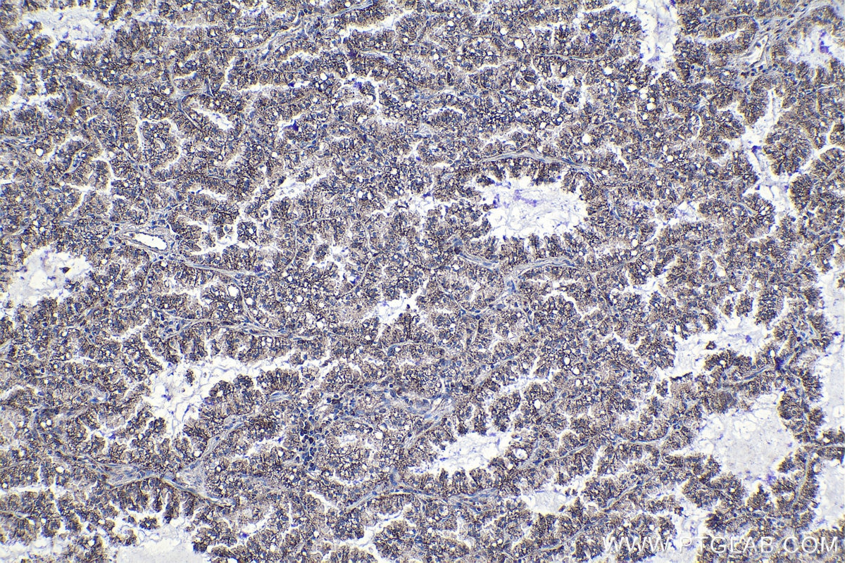 Immunohistochemical analysis of paraffin-embedded human lung cancer tissue slide using KHC1147 (SLC11A1 IHC Kit).