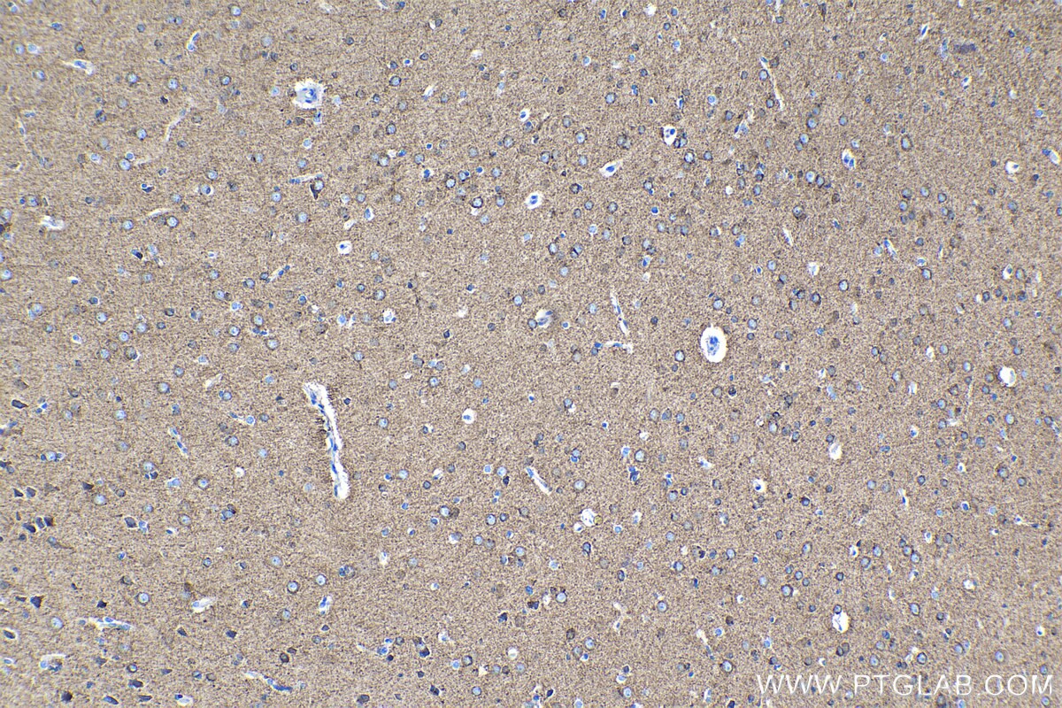 Immunohistochemical analysis of paraffin-embedded human gliomas tissue slide using KHC1344 (SLC12A5 IHC Kit).