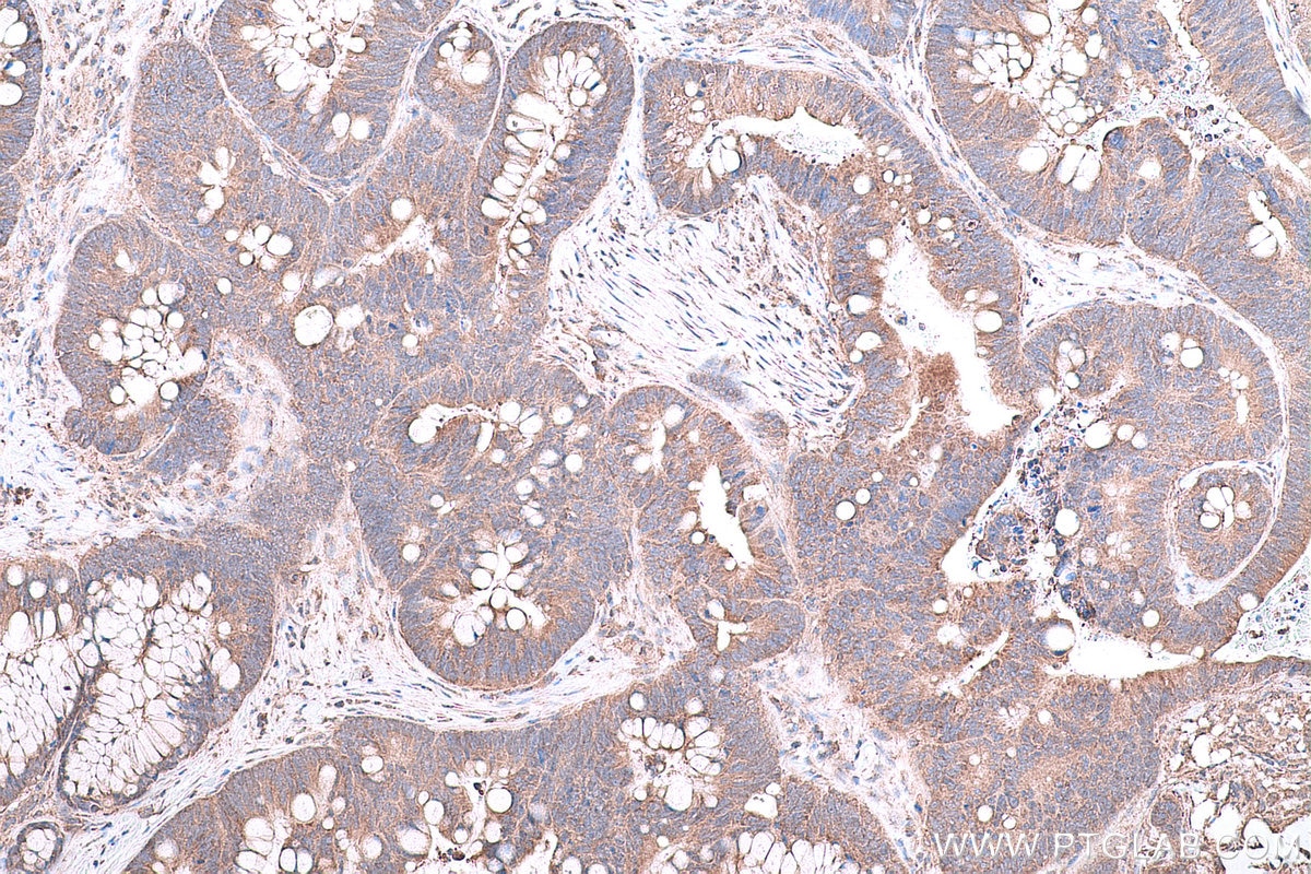 Immunohistochemical analysis of paraffin-embedded human colon cancer tissue slide using KHC0809 (SLC16A12 IHC Kit).