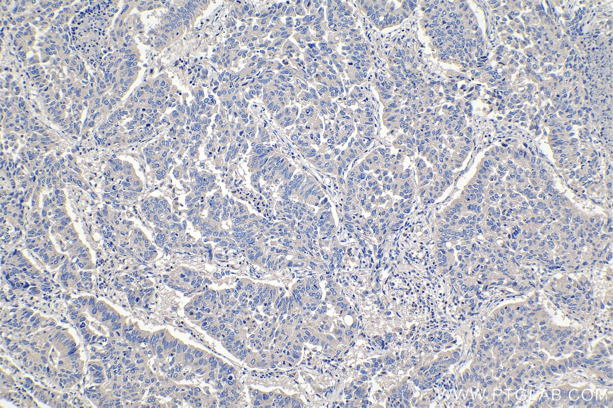 Immunohistochemical analysis of paraffin-embedded human lung cancer tissue slide using KHC1087 (SLC25A42 IHC Kit).