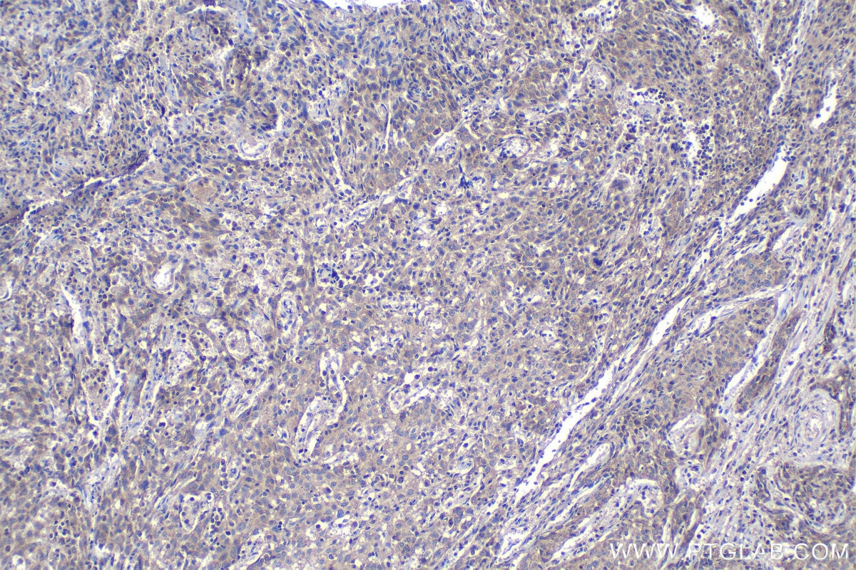 Immunohistochemical analysis of paraffin-embedded human cervical cancer tissue slide using KHC1148 (SLC25A5 IHC Kit).