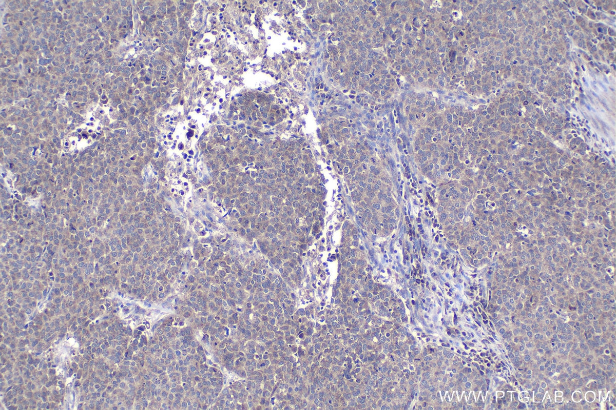 Immunohistochemical analysis of paraffin-embedded human stomach cancer tissue slide using KHC1148 (SLC25A5 IHC Kit).