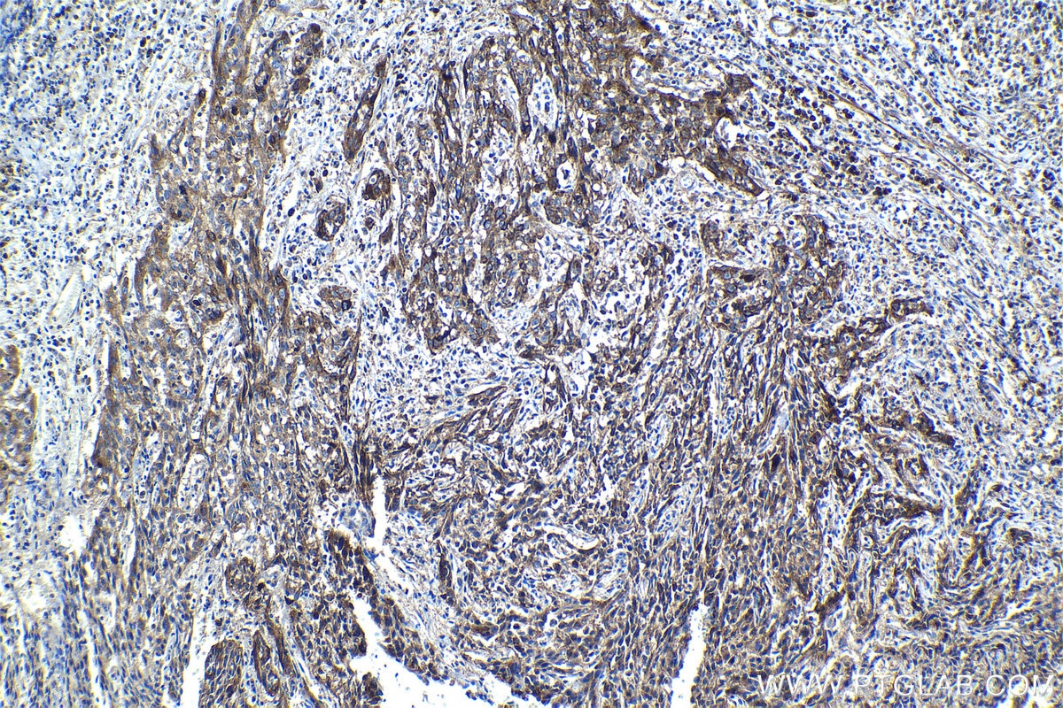 Immunohistochemical analysis of paraffin-embedded human cervical cancer tissue slide using KHC1215 (SLC38A2 IHC Kit).