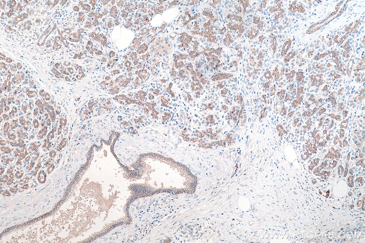 Immunohistochemical analysis of paraffin-embedded human pancreas cancer tissue slide using KHC0196 (SLC4A4 IHC Kit).