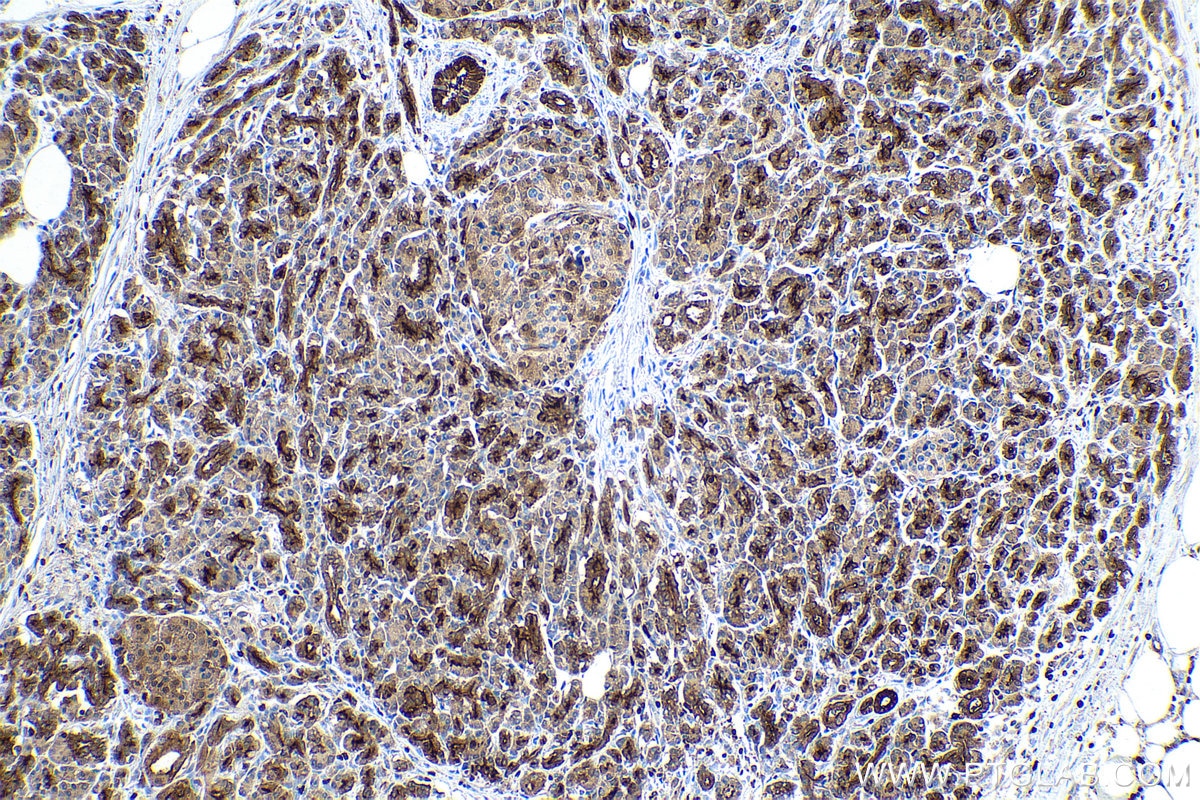 Immunohistochemical analysis of paraffin-embedded human pancreas cancer tissue slide using KHC0891 (SLC9A3R1 IHC Kit).