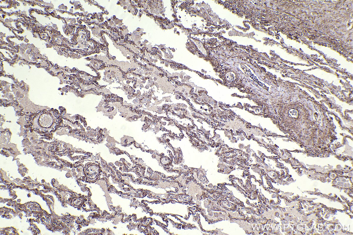 Immunohistochemical analysis of paraffin-embedded human lung cancer tissue slide using KHC2277 (SLCO1A2 IHC Kit).