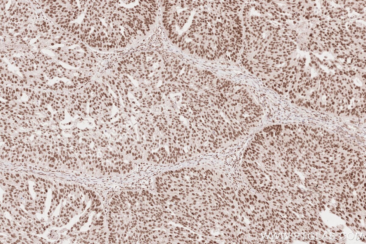 Immunohistochemical analysis of paraffin-embedded human ovary cancer tissue slide using KHC2629 (SLFN11 IHC Kit).