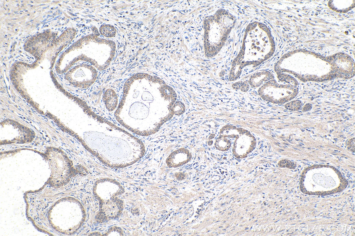 Immunohistochemical analysis of paraffin-embedded human prostate cancer tissue slide using KHC1493 (SLU7 IHC Kit).