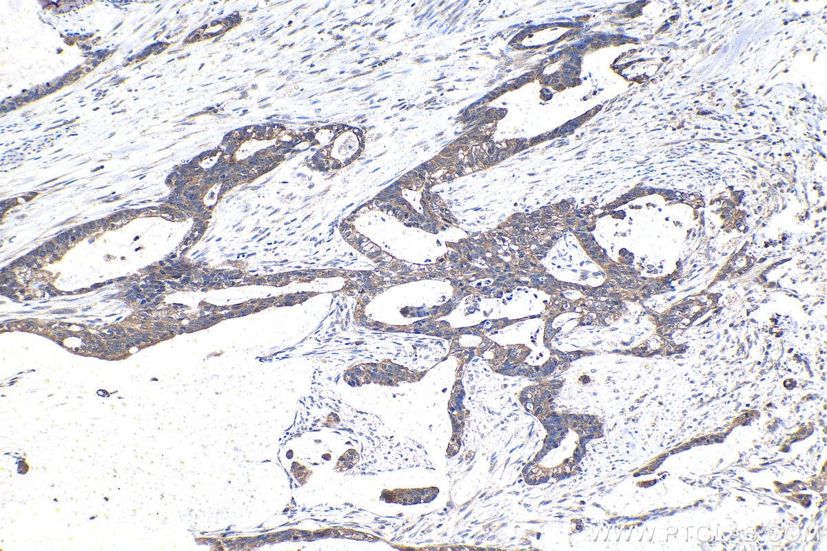 Immunohistochemical analysis of paraffin-embedded human urothelial carcinoma tissue slide using KHC1493 (SLU7 IHC Kit).