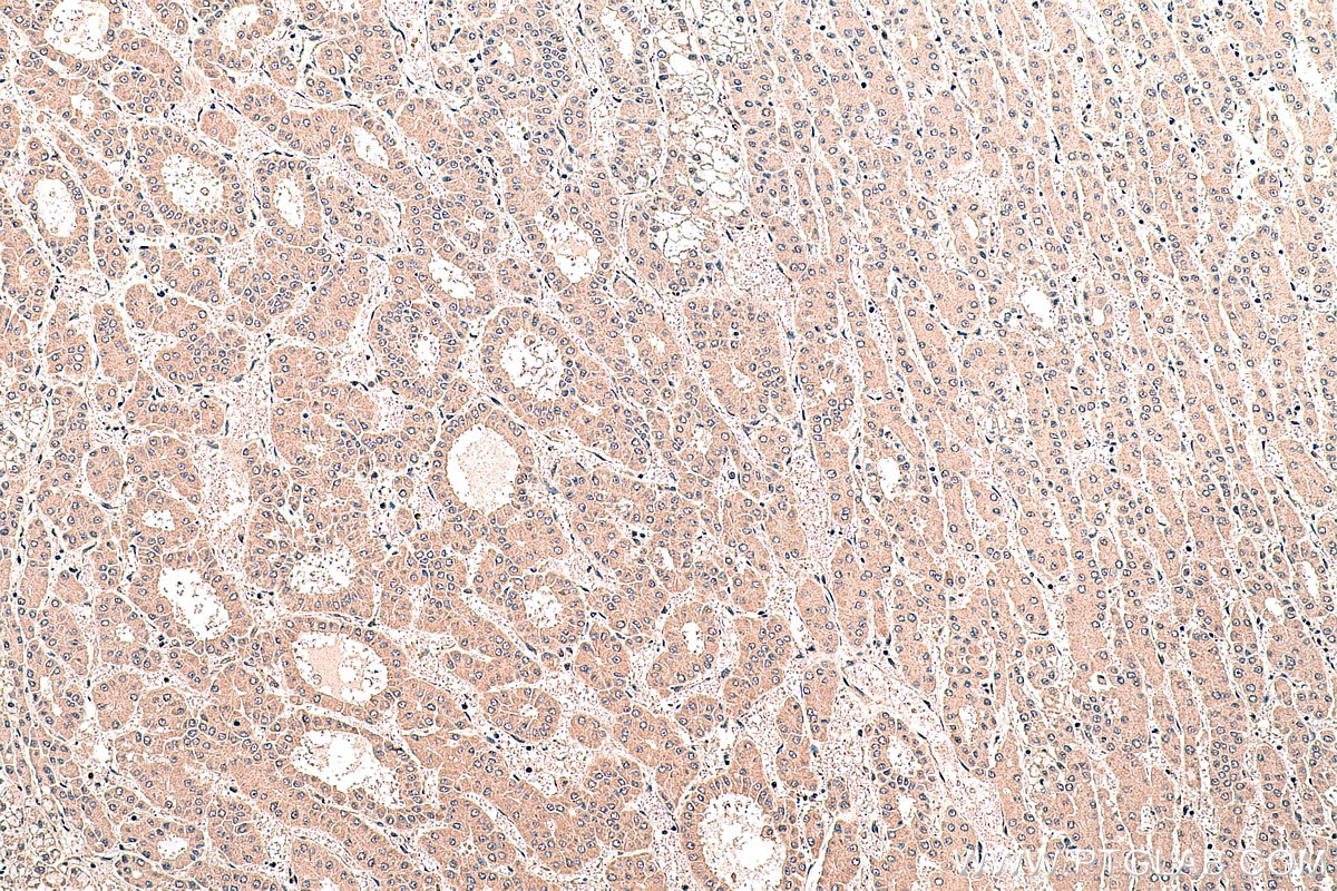 Immunohistochemical analysis of paraffin-embedded human liver cancer tissue slide using KHC0389 (SMAD1 IHC Kit).