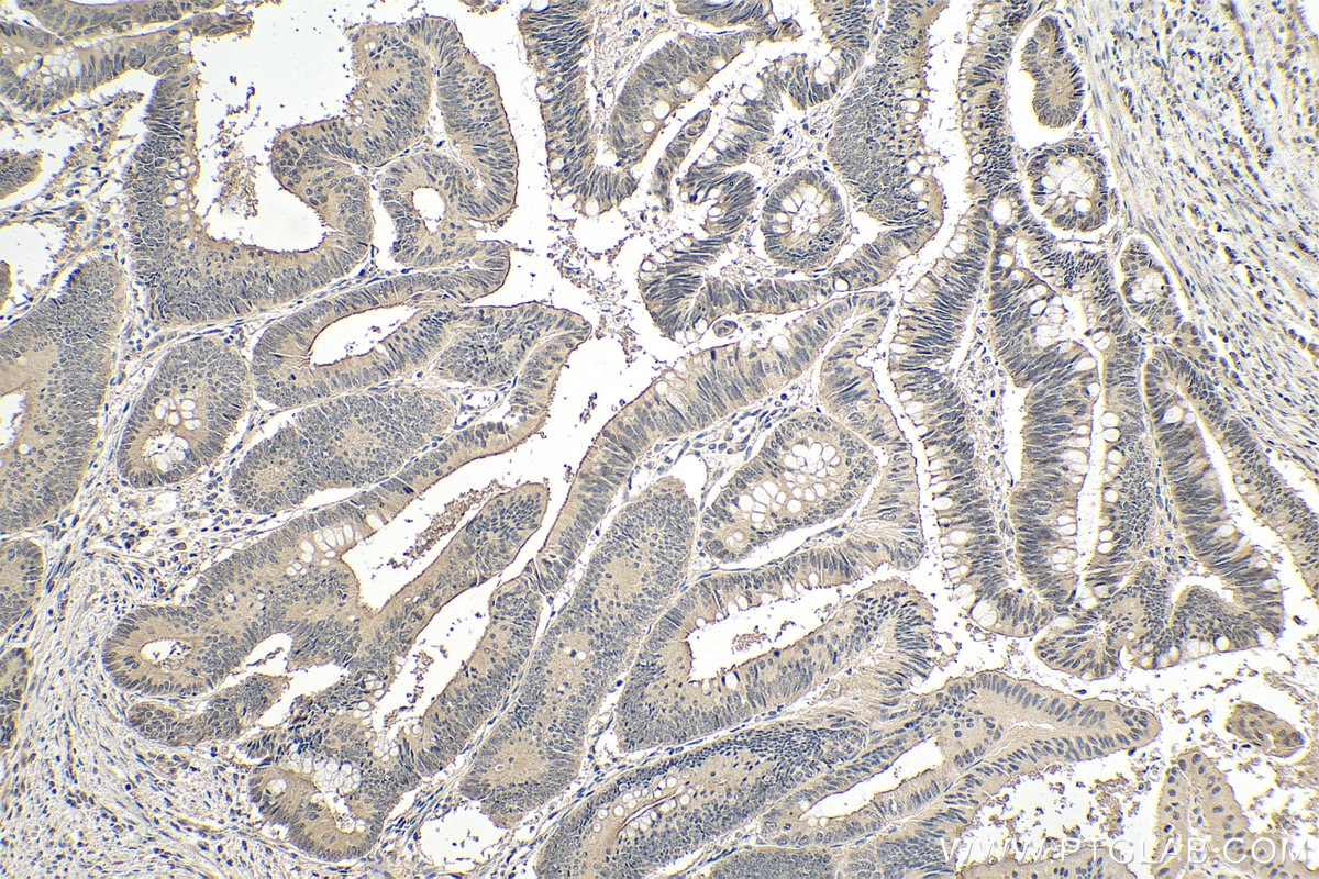 Immunohistochemical analysis of paraffin-embedded human colon cancer tissue slide using KHC0126 (SMAD2 IHC Kit).