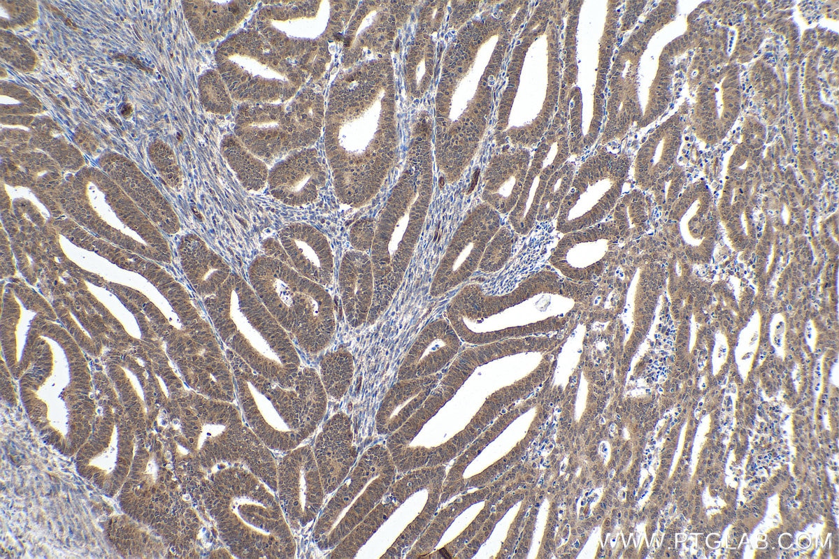 Immunohistochemical analysis of paraffin-embedded human endometrial cancer tissue slide using KHC0126 (SMAD2 IHC Kit).