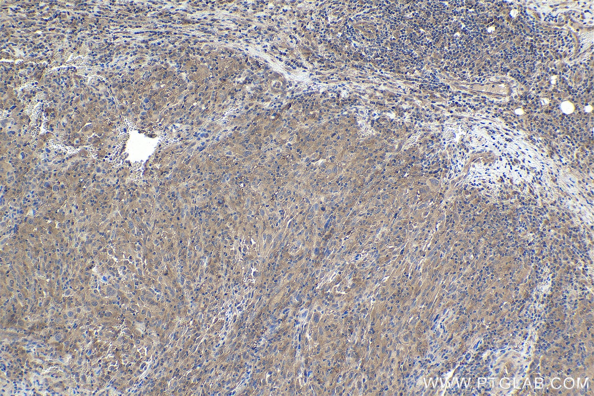 Immunohistochemical analysis of paraffin-embedded human skin cancer tissue slide using KHC1713 (SMAD4 IHC Kit).