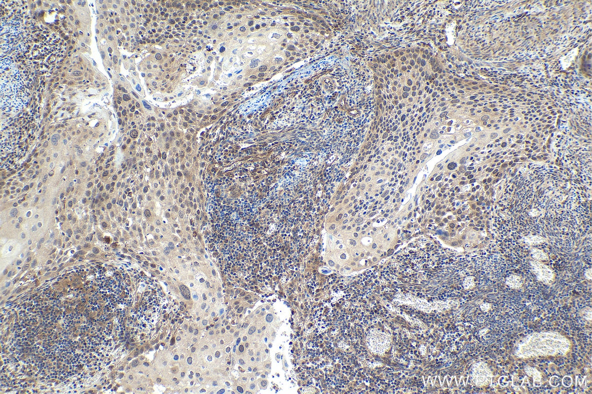 Immunohistochemical analysis of paraffin-embedded human cervical cancer tissue slide using KHC1713 (SMAD4 IHC Kit).
