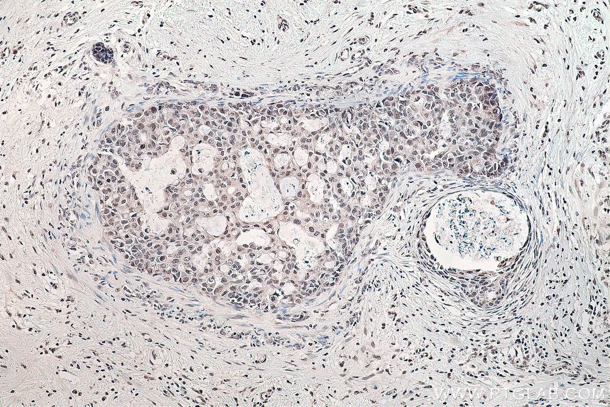 Immunohistochemical analysis of paraffin-embedded human breast cancer tissue slide using KHC0127 (SMAD7 IHC Kit).