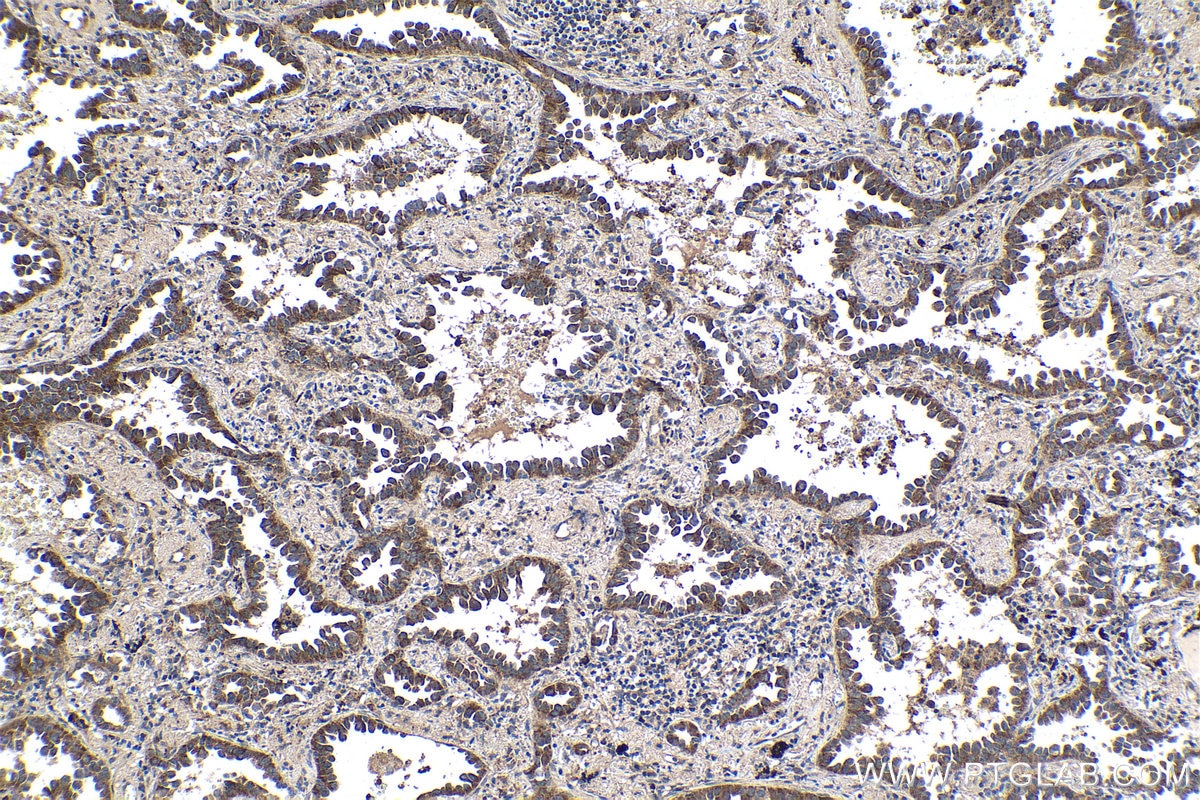 Immunohistochemical analysis of paraffin-embedded human lung cancer tissue slide using KHC1441 (SMAD9 IHC Kit).